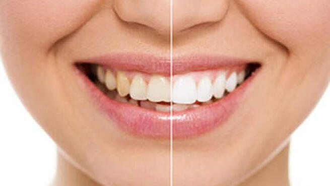 Blanqueamiento Dental Con Luz Led En Clinica Dental Galdo Por 43 Oferta Con Descuento 64 Ofertas En Granada Oferplan Ideal